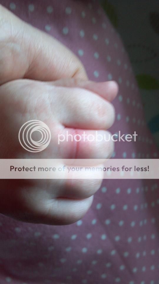 Hair Tourniquet? — The Bump